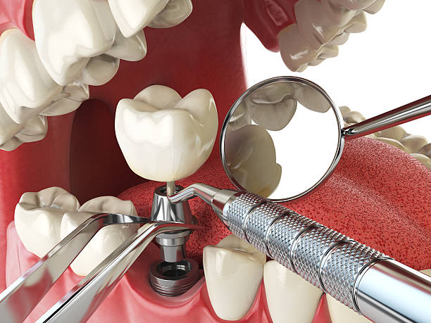 Best Emergency Dental Care for Broken or Chipped Teeth in Stepping Stone, CO
